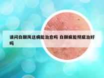 请问白颠风这病能治愈吗 白颠疯能彻底治好吗