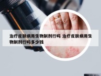 治疗皮肤病用生物制剂行吗 治疗皮肤病用生物制剂行吗多少钱