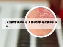 大腿根部股癣图片 大腿根部股癣症状图片展示