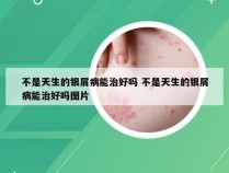 不是天生的银屑病能治好吗 不是天生的银屑病能治好吗图片