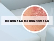 银屑病发痒怎么办 银屑病痒痒的厉害怎么办