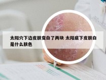 太阳穴下边皮肤变白了两块 太阳底下皮肤白是什么肤色