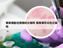 银屑病能吃微辣的火锅吗 银屑病可以吃火锅吗