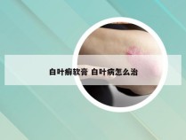 白叶癣软膏 白叶病怎么治