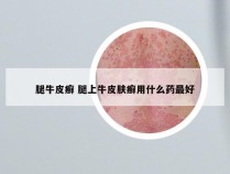 腿牛皮癣 腿上牛皮肤癣用什么药最好