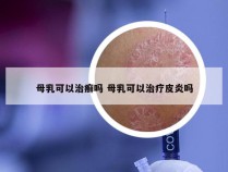 母乳可以治癣吗 母乳可以治疗皮炎吗