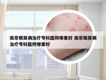 南京银屑病治疗专科医院哪里好 南京银屑病治疗专科医院哪里好