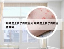 眼睛皮上长了白斑图片 眼睛皮上长了白斑图片真实