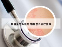 银屑是怎么治疗 银屑怎么治疗有效