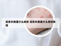 后背长癣是什么症状 后背长癣是什么症状表现