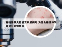 扁桃体发炎能引发银屑病吗 为什么扁桃体发炎会引起银屑病