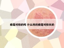 癣是对称的吗 什么样的癣是对称长的