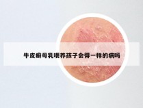 牛皮癣母乳喂养孩子会得一样的病吗