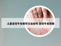 儿童急性牛皮癣可以治愈吗 急性牛皮肤癣