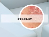 白癜风这么治疗