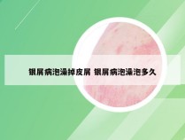 银屑病泡澡掉皮屑 银屑病泡澡泡多久