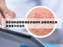 银屑病和副银屑病症状相同吗 副银屑病比银屑病更不好治吗