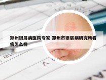 郑州银屑病医院专家 郑州市银屑病研究所看病怎么样