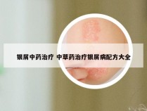 银屑中药治疗 中草药治疗银屑病配方大全