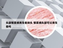 头部银屑病用生姜抹头 银屑病头部可以用生姜吗