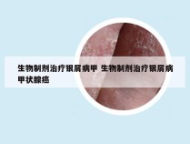 生物制剂治疗银屑病甲 生物制剂治疗银屑病甲状腺癌