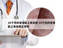 16个月的宝宝脸上有白斑 16个月的宝宝脸上有白斑正常吗