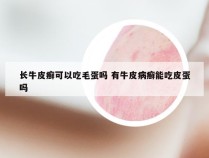 长牛皮癣可以吃毛蛋吗 有牛皮病癣能吃皮蛋吗