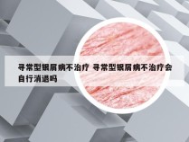 寻常型银屑病不治疗 寻常型银屑病不治疗会自行消退吗