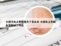 小孩子头上有癣变大了怎么办 小孩头上长癣头发都掉了咋办