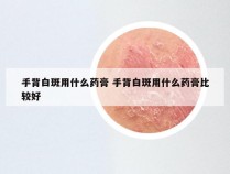 手背白斑用什么药膏 手背白斑用什么药膏比较好