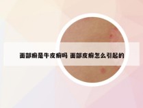 面部癣是牛皮癣吗 面部皮癣怎么引起的