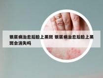 银屑病治愈后脸上黑斑 银屑病治愈后脸上黑斑会消失吗