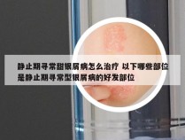 静止期寻常甜银屑病怎么治疗 以下哪些部位是静止期寻常型银屑病的好发部位