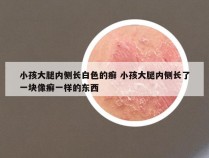 小孩大腿内侧长白色的癣 小孩大腿内侧长了一块像癣一样的东西