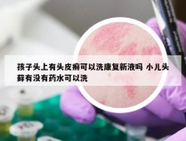 孩子头上有头皮癣可以洗康复新液吗 小儿头藓有没有药水可以洗