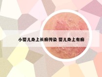 小婴儿身上长癣传染 婴儿身上有癣