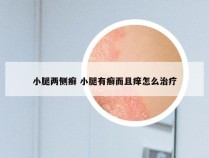 小腿两侧癣 小腿有癣而且痒怎么治疗