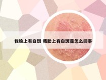 我脸上有白斑 我脸上有白斑是怎么回事