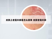 皮肤上老是长癣是怎么回事 皮肤老是长藓