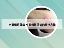 小面积银屑病 小面积银屑病的治疗方法