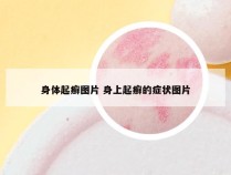 身体起癣图片 身上起癣的症状图片