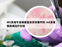 MD多维牛皮癣康复体系效果咋样 md多维银屑病治疗价格