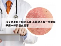 孩子腿上起干癣怎么办 小孩腿上有一圈类似干癣一样的怎么回事