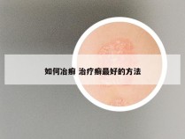 如何冶癣 治疗癣最好的方法