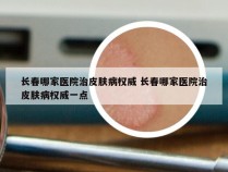 长春哪家医院治皮肤病权威 长春哪家医院治皮肤病权威一点