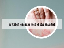 洗完澡后皮肤红癣 洗完澡后皮肤红癣痒