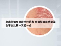 点滴型银屑病治疗时总发 点滴型银屑病复发会不会比第一次轻一点