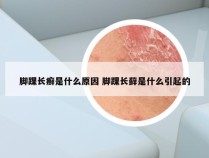 脚踝长癣是什么原因 脚踝长藓是什么引起的