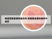 脓疱型银屑病有偏方吗 脓疱银屑病吃哪种中成药