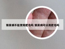 银屑病不能使用肥皂吗 银屑病可以用肥皂吗